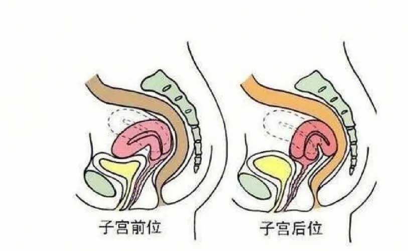 女人子宫后位会导致女性不孕吗？