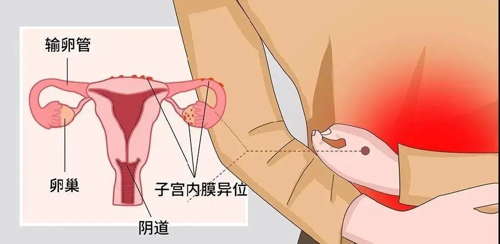 如何自查子宫内膜异位症?