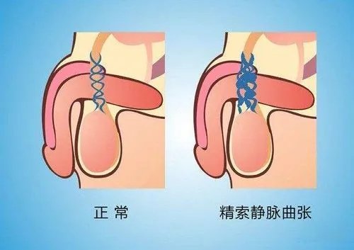 为什么男性会发生精索静脉曲张?